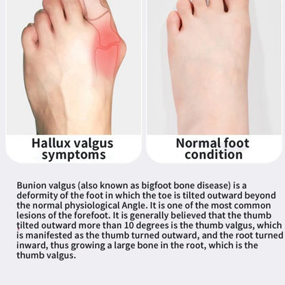 StepAlign™ Bunion Corrector – Orthopedic Toe Separator & Thumb Adjuster